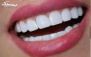کامپوزیت کاریزما در دندانپزشکی دکتر کثیری