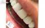 کامپوزیت آمریکایی واحدی در دندانپزشکی سارا گل