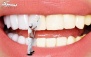بلیچینگ هر فک آلمانی در دندانپزشکی عاج
