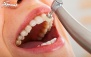 جرمگیری و بروساژ دو فک در مرکز دندانپزشکی سپیدار