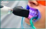 ترمیم یک سطحی کامپوزیت در دندانپزشکی رویالدنت