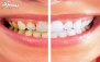 ترمیم یک سطحی امالگام در دندانپزشکی رویالدنت