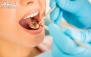 پر کردن با آمالگام در دندانپزشکی دکترفخر طباطبایی