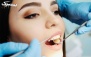 عصب کشی دندان شش با پر کردن در دندانپزشکی شکوفه