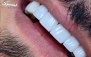 ونیر کامپوزیت ایتالیایی در مطب دندانپزشکی قلهک