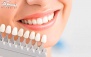 بليچينگ دندان در دندانپزشکی الماس