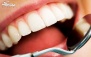 بیلیچینگ دندان با دکتر عزیزی