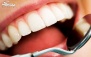 بیلیچینگ دندان دردندانپزشکی صبا