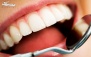 جرم گیری دندان در درمانگاه سپید سلامت